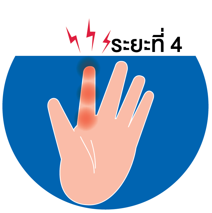 โรคนิ้วล็อค Trigger Finger สาเหตุ อาการ การรักษา | รพ. นนทเวช โรคนิ้วล็อค Trigger Finger สาเหตุ อาการ การรักษา | รพ. นนทเวช